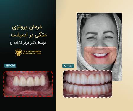 نمونه درمان All-on-X و بازسازی کامل فک توسط دکتر عزیز گشاده&zwnj;رو